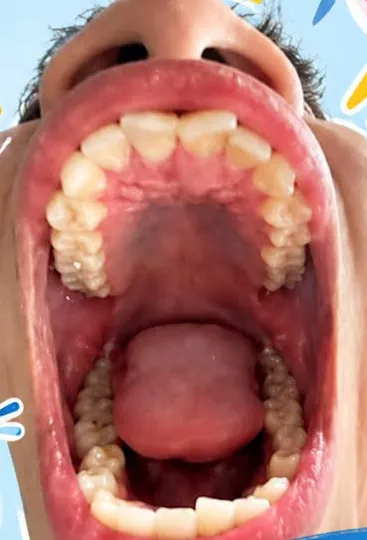 Khám răng tổng quát