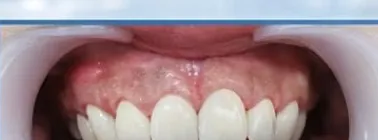 Trám răng thẩm mỹ