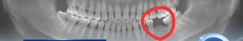 Cắm implant / cầu răng sứ